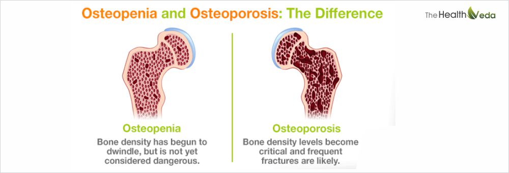 Osteoporosis