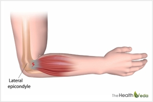 A-technical-look-What-happens-in-tennis-elbow