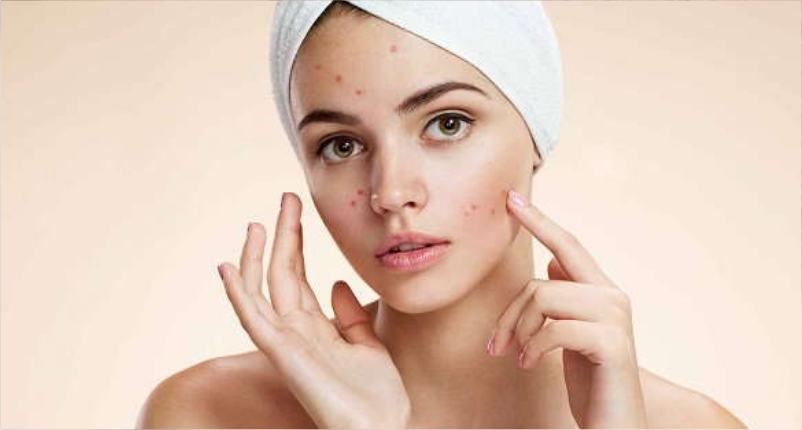 Health-Benefits-of-Honey-and-Cinnamon-to-Combats-Acne