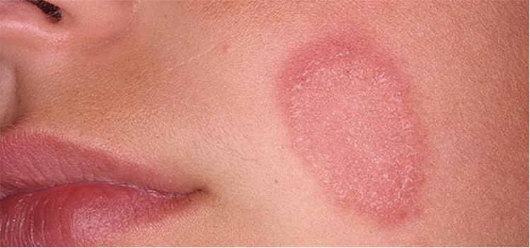 How to Get Rid of Brown Spots on skin with Simple Home Remedies?
