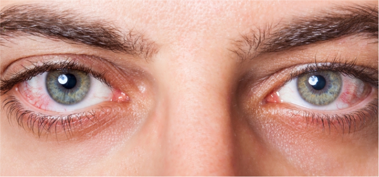How to Get Rid of Eye Redness with Simple Remedies? Know Here!